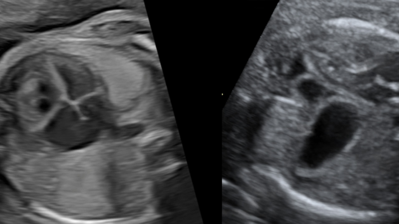 An ultrasound image of an unborn baby with congenital diaphragmatic hernia.
