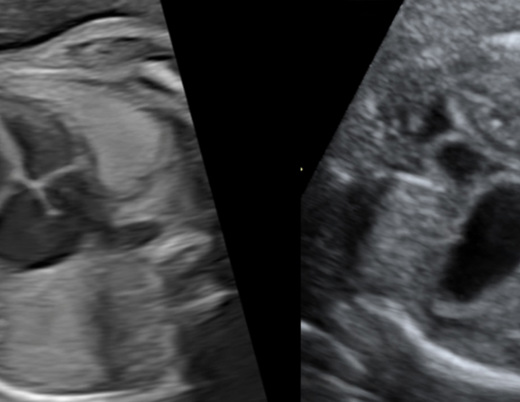 An ultrasound image of an unborn baby with congenital diaphragmatic hernia.