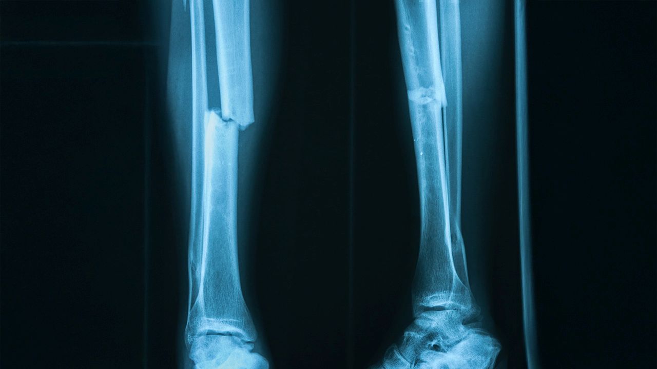  X-ray of the lower leg showing a clear fracture in the tibia. 