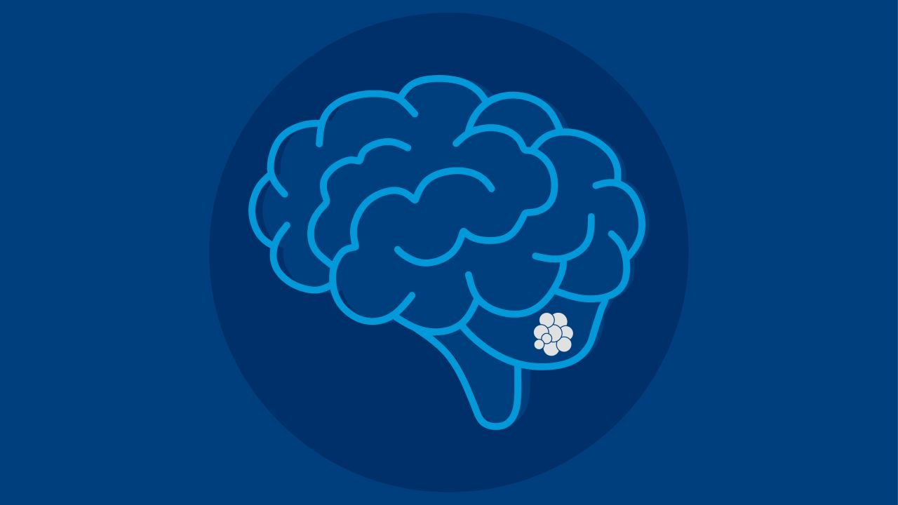 Illustration of a brain with a highlighted cluster of cells in the lower right portion, representing a neurological condition or area of focus.