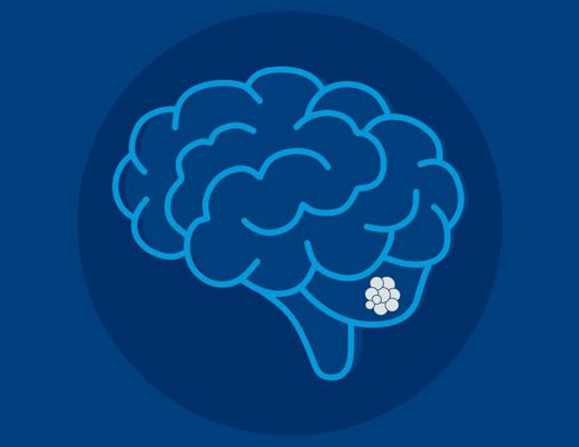 Illustration of a brain with a highlighted cluster of cells in the lower right portion, representing a neurological condition or area of focus.