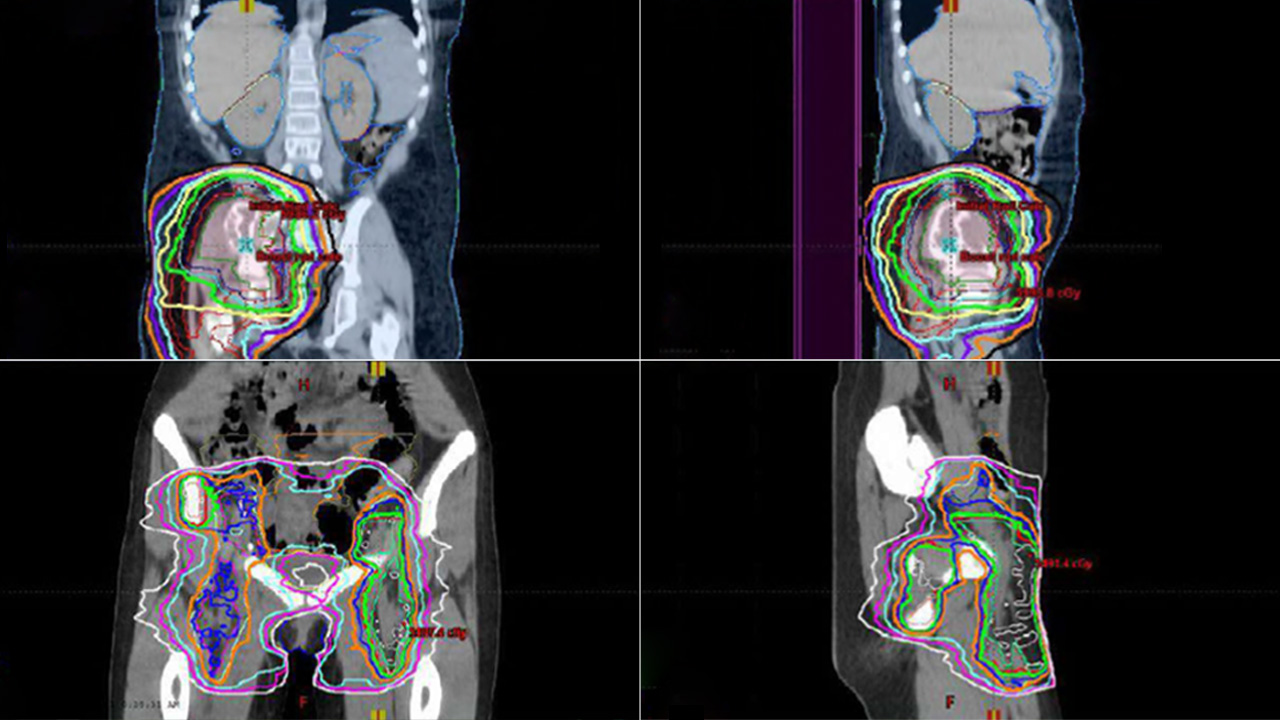 Pelvic External Beam Radiation Therapy