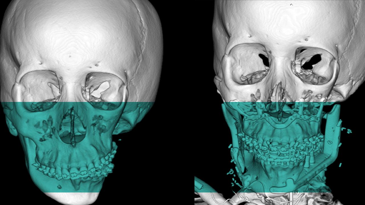 A before and after X-ray of Ashley’s jaw after it was created.