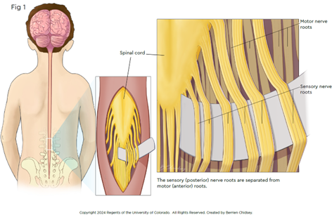 Image representing the sensory nerve roots being separated from motor roots