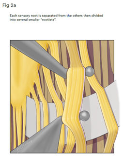 Image showing each sensory root being separated from the others then divided into several smaller rootlets