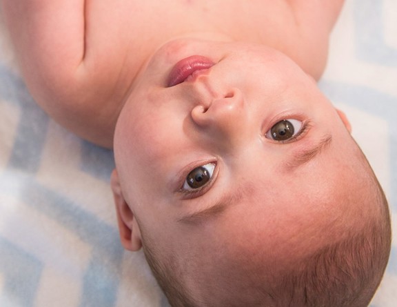 A closeup of a baby treated for hypoplastic left heart syndrome (HLHS) at Children's Hospital Colorado.