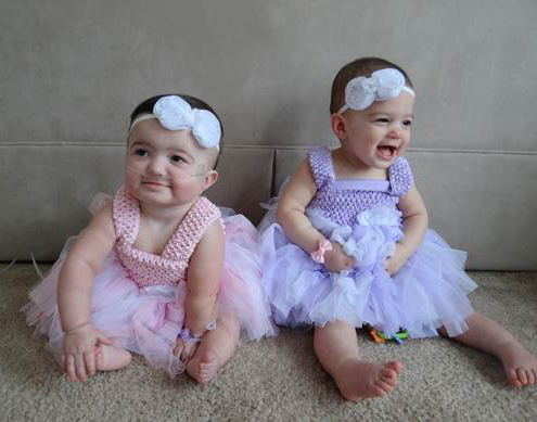 Two TTTS twin girls is a pink and blue dress. 