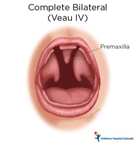 An artist's drawing of a baby's open mouth. In the back of the mouth, the flesh is disconnected and there is a line to the part in the middle that says Premaxilla.