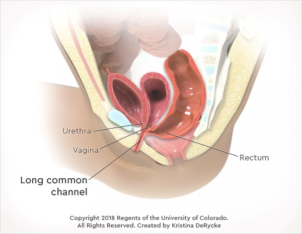Illustration showing a cloacal malformation with a long common channel (more than 5 cm in length).