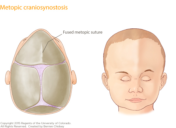 An illustration of a baby's skull with the front two plates fused together and labeled Fused metotopic suture. Next to it is an illustration of a baby's head showing the skull protruding out in a line down the center of the forehead.