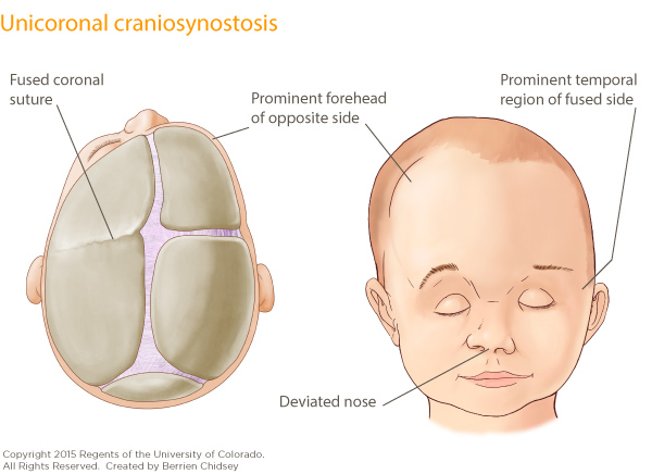 An illustration of a baby's skulls with the two plates on the left side fused together and labeled Fused coronal suture. Next to it is an illustration of a baby's head showing a prominent forehead on the opposite side of the suture, a prominent temporal region near the eye on the fused side, and a deviated nose.