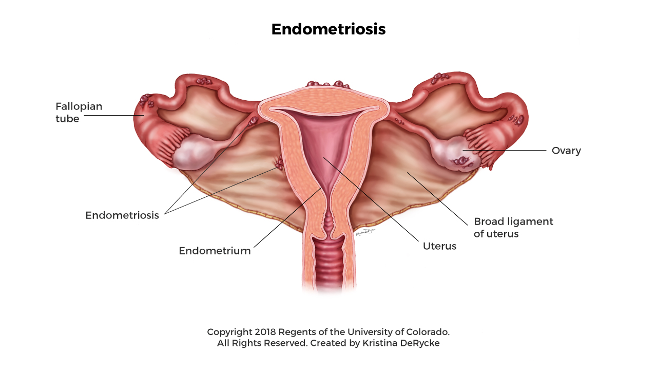 Endometriosis illustration