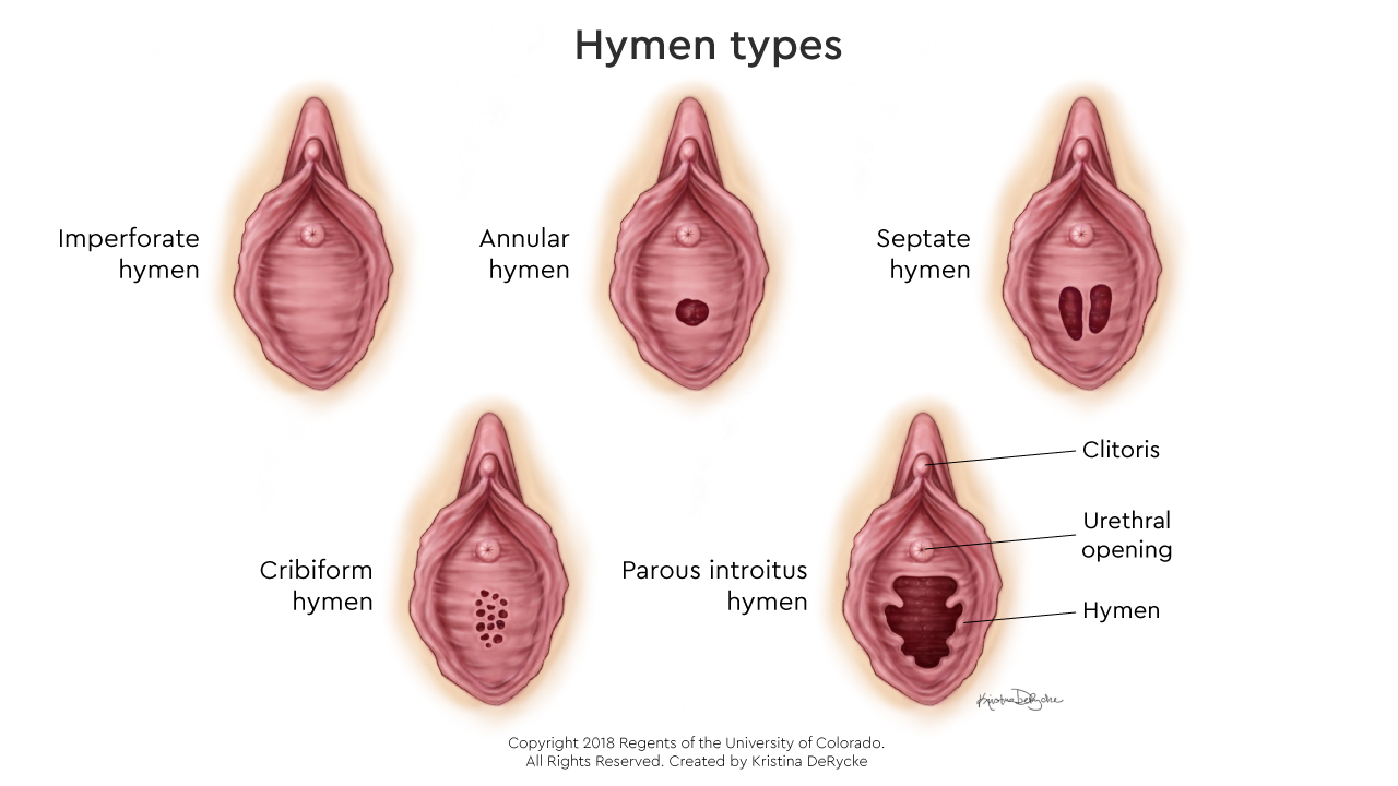 Drawing shows the different types of hymens that may occur as a result of the imperforate hymen condition.