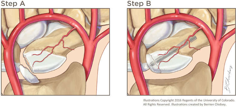 A graphic illustration of how we treat scaphoid fracture at Children's Hospital Colorado.