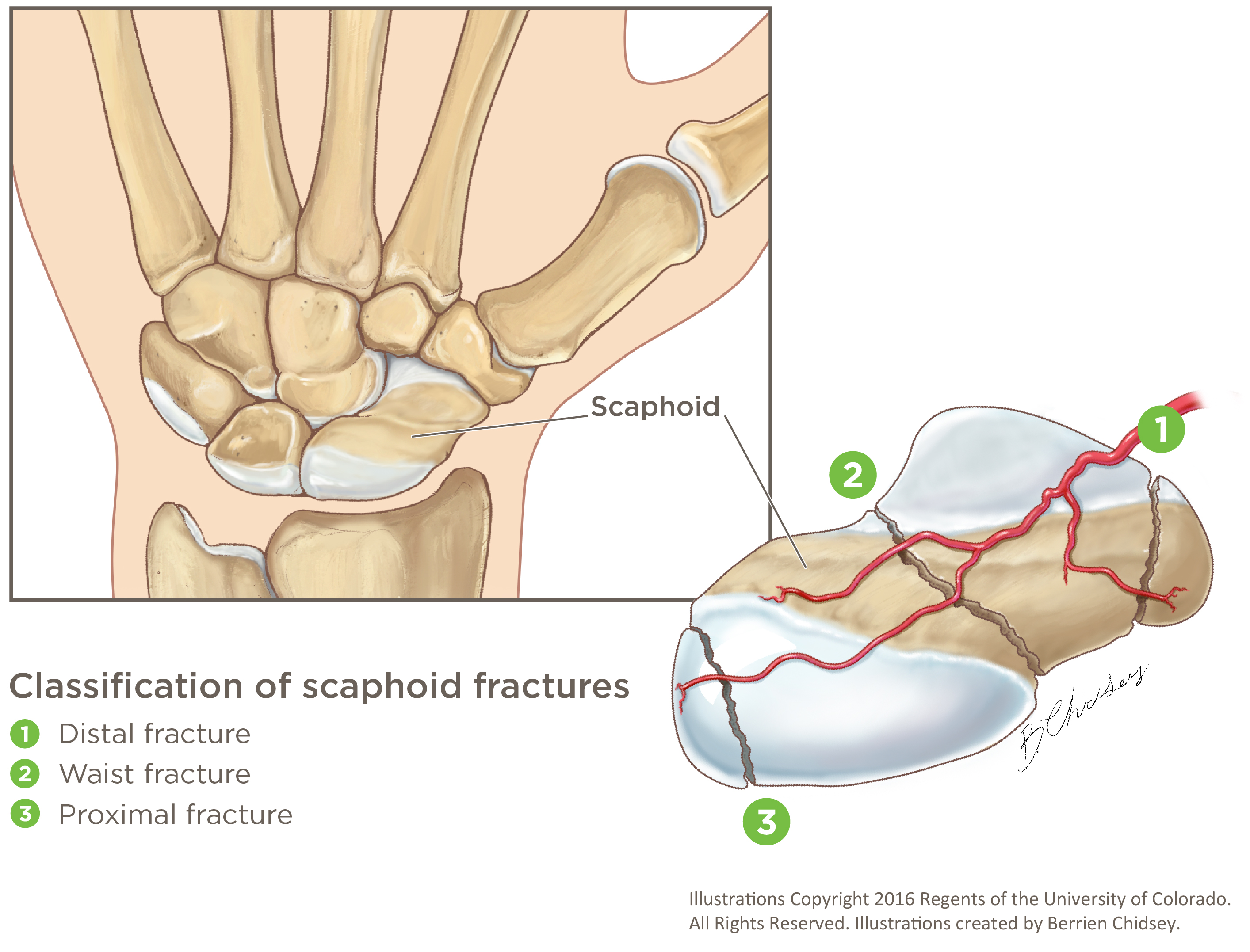 Scaphoid Fracture A graphic illustration of three types of scaphoid fractures: distal, waist and proximal.