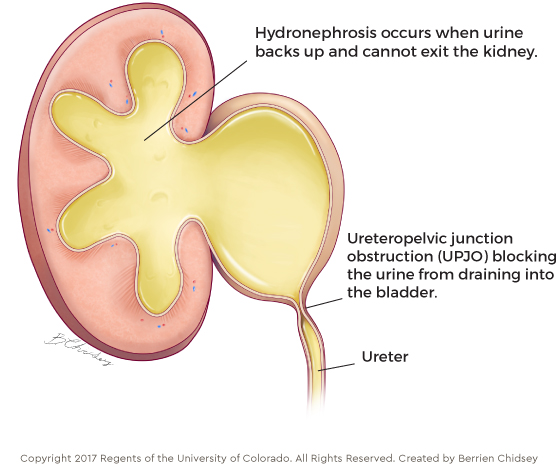 Ureteropelvic Junction Obstruction This illustration shows a kidney affected by ureteropelvic junction obstruction, which leads to hydronephrosis.