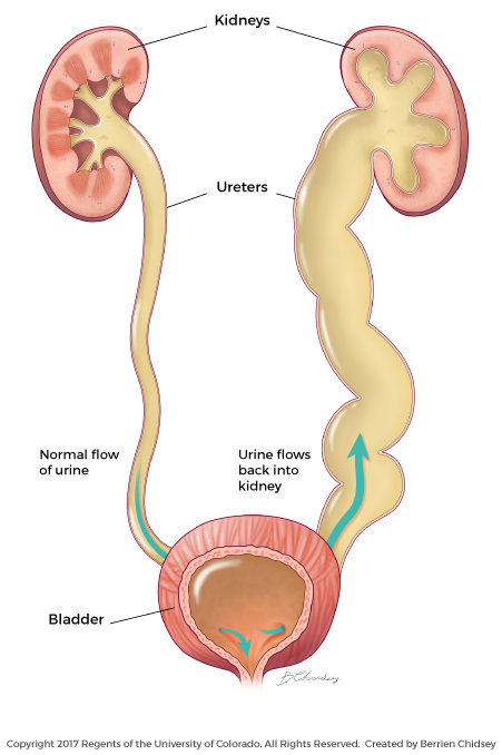 Vesicoureteral Reflux This illustration shows vesicoureteral reflux, which is the backflow of urine from the bladder to the kidneys through the ureters.