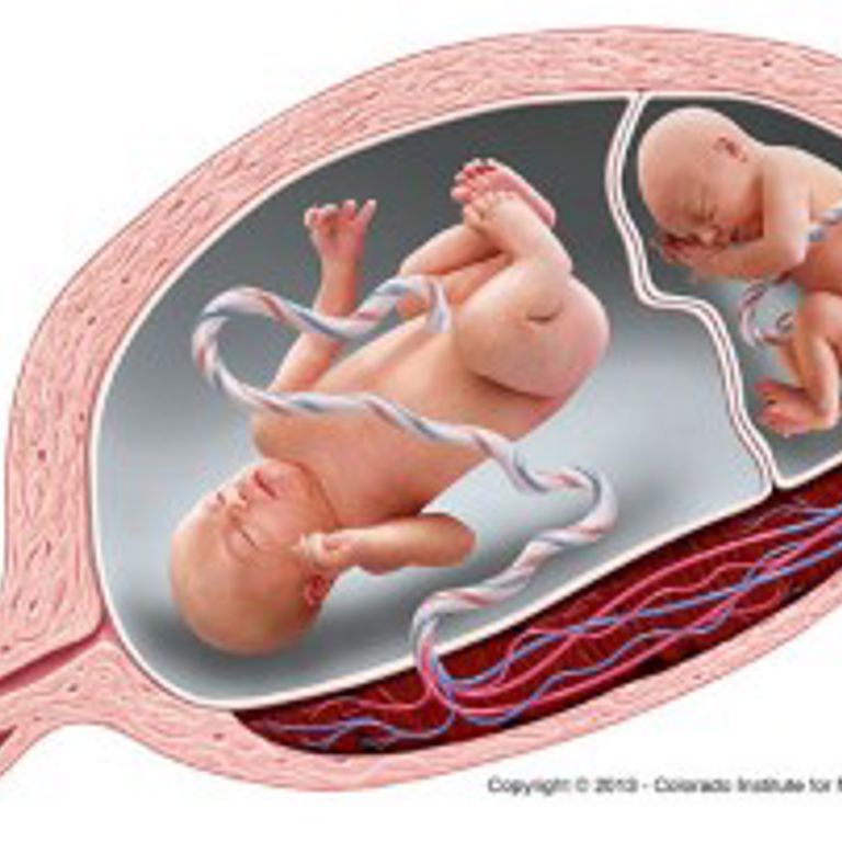 A graphic illustration of twin-to-twin transfusion syndrome.