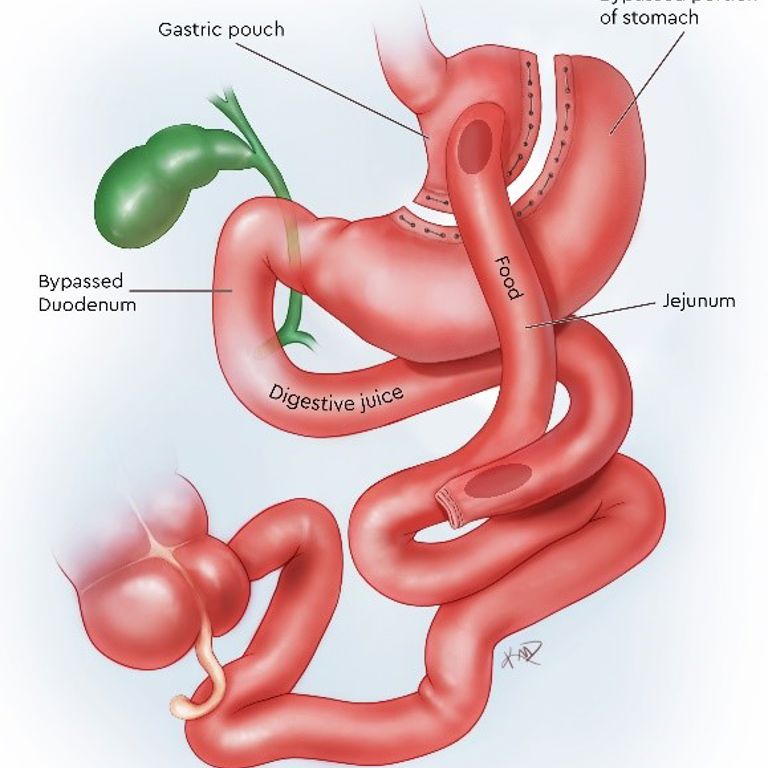 Graphic illustration showing the bypassed portion of the stomach and how food flows from the gastric pouch.