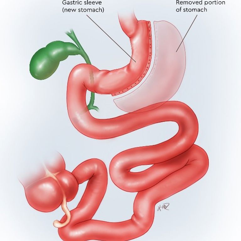 Graphic illustration showing the removed portion of the stomach and how the gastric sleeve becomes the new stomach.