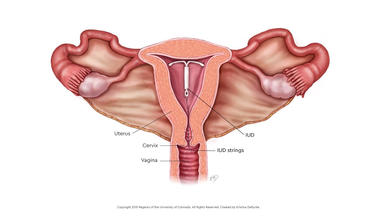 An illustration of what the IUD looks like after it&rsquo;s been inserted into the uterus.