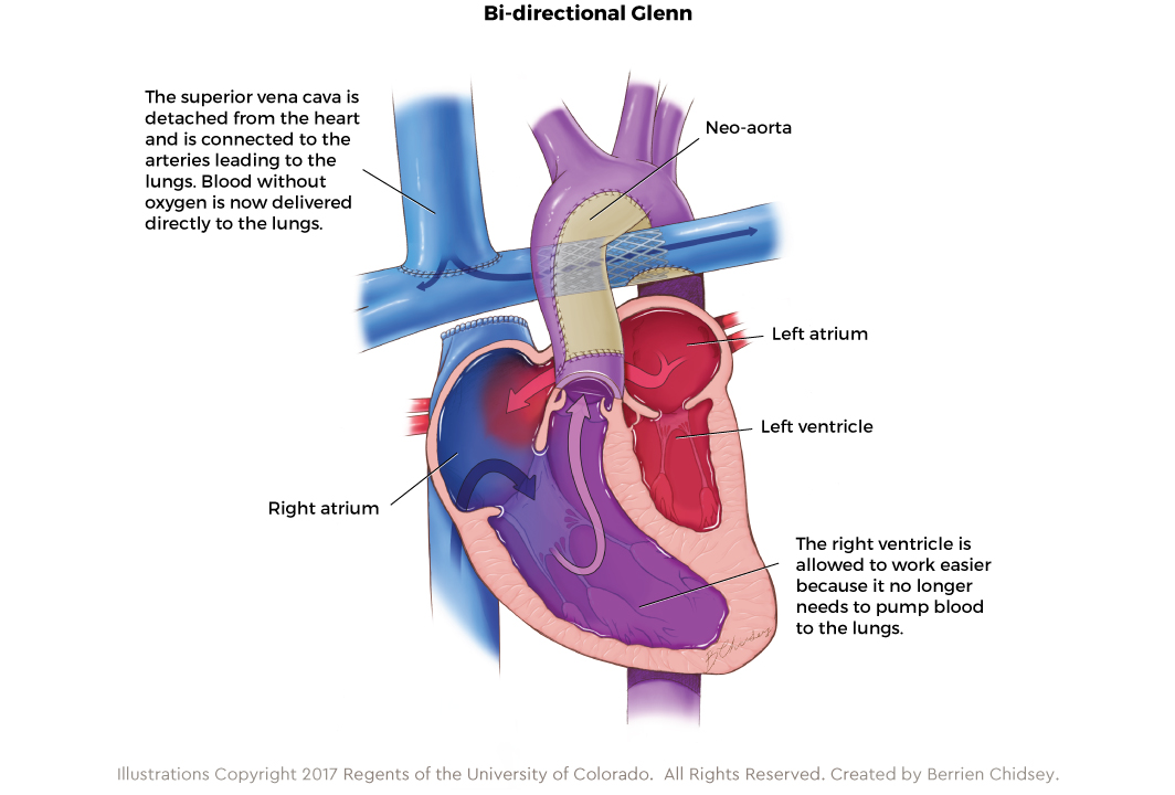 Graphic showing the bi-directional Glenn procedure for HLHS