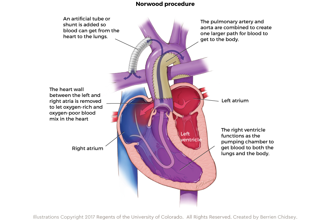 Norwood procedure Graphic showing the Norwood procedure for HLHS