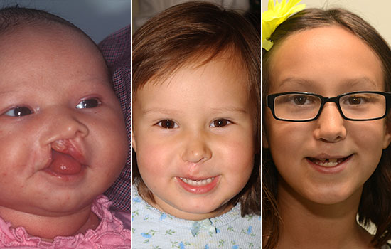 Three close-up pictures of the same girl before and after cleft surgery. The first picture is before surgery as a baby. The second picture is as a toddler after surgery. The third picture is as a kid after the scar healed.