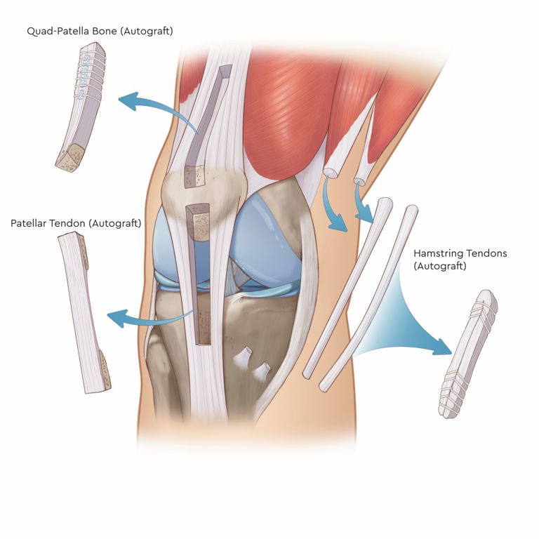 Illustration showing that an ACL graft can come from the quad-patella bone above the knee, the patellar tendon below the knee or the hamstring tendons on the side of the knee.