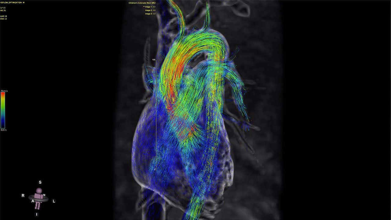 4D MRI of heart with color-coded blood flow.