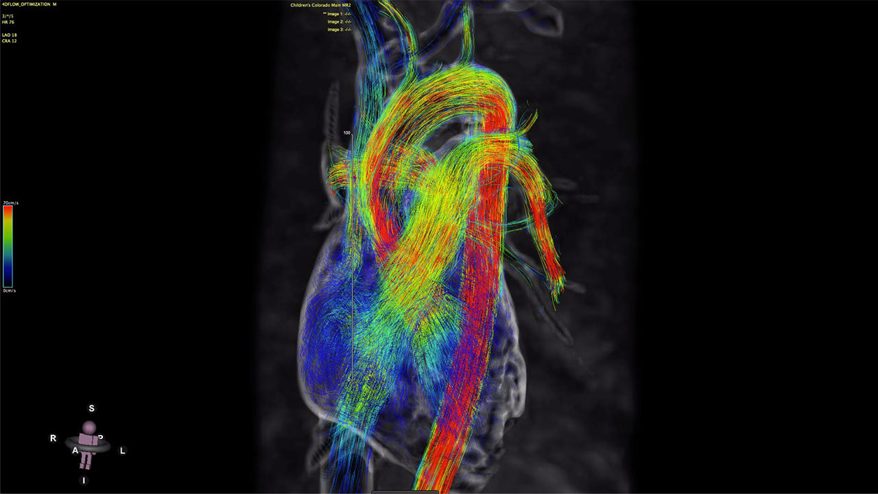 4D MRI of heart with color-coded blood flow.