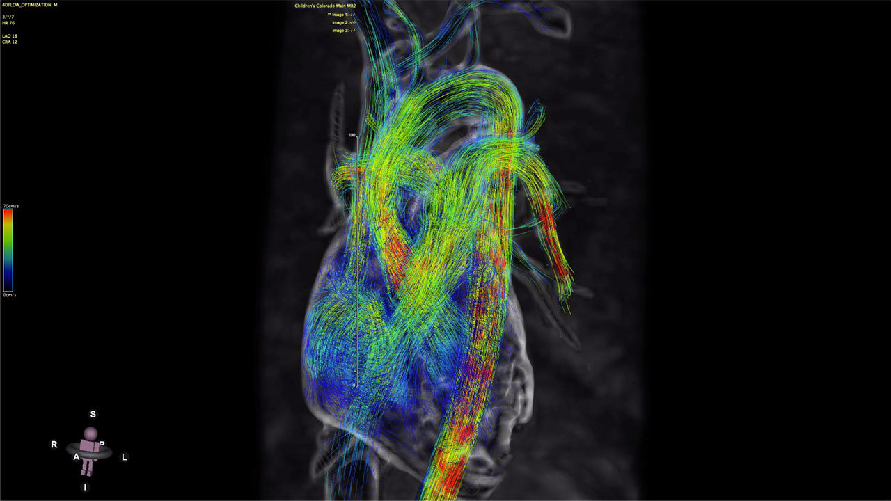 4D MRI of heart with color-coded blood flow.