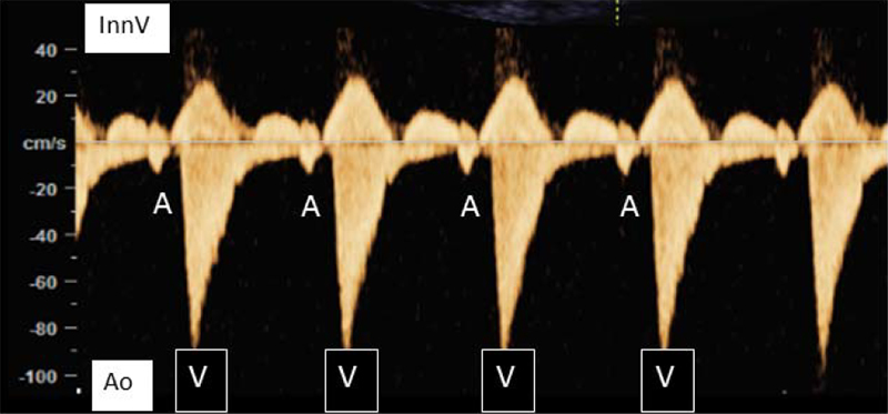 A graph-like image of a fetus in sinus rhythm with a normal AV interval of 125 ms. There is a y-axis of cm/s labeled from -100 to 40. There is a yellowish wave along x-axis.