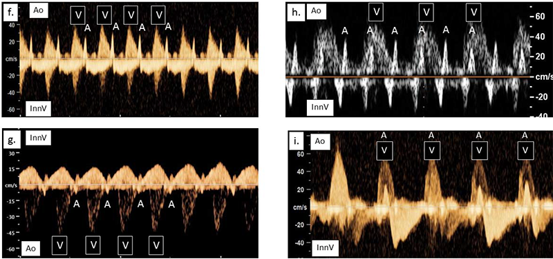 Four graph-like images where there is a y-axis of cm/s labeled from -100 to 40 and yellowish waves along x-axis each portraying different fetal heart rhythms.